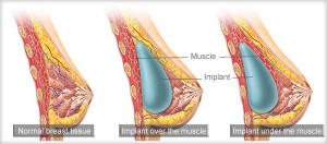 breast implants positions virgnia placement postion