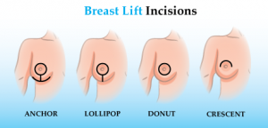 breast lift scars virginia