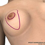 breast lift surgery illustrations 1