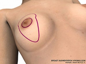 breast lift surgery illustrations 1