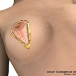 breast lift surgery illustrations 2