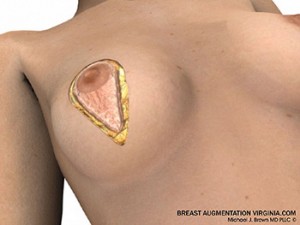 breast lift surgery illustrations 2