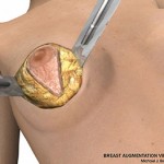 breast lift surgery illustrations 3