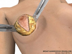 breast lift surgery illustrations 3