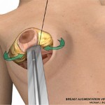breast lift surgery illustrations 4