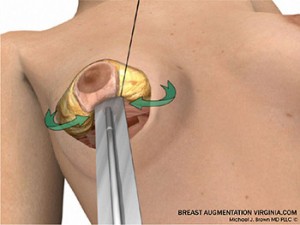 breast lift surgery illustrations 4