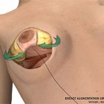 breast lift surgery illustrations 5