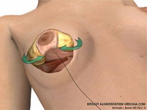 breast lift surgery illustrations 5