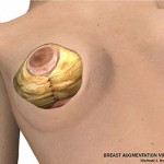 breast lift surgery illustrations 6