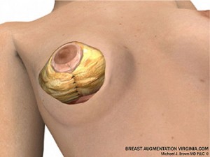 breast lift surgery illustrations 6