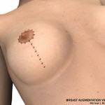 breast lift surgery illustrations 7