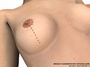 breast lift surgery illustrations 7