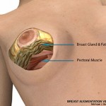 breast reduction surgery illustration