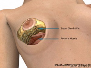 breast reduction surgery illustration