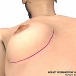 breast augmentation surgery illustrations