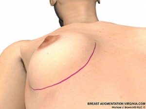 breast augmentation surgery illustrations