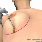 breast augmentation surgery illustrations