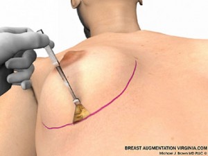 breast augmentation surgery illustrations
