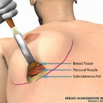 breast augmentation surgery illustrations