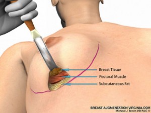 breast augmentation surgery illustrations