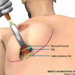 breast augmentation surgery illustrations