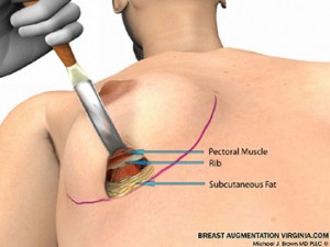 breast augmentation surgery illustrations