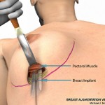 breast augmentation surgery illustrations