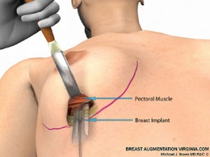 breast augmentation surgery illustrations