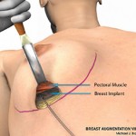 breast augmentation surgery illustrations