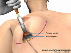 breast augmentation surgery illustrations