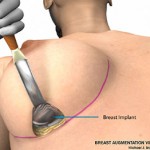 breast augmentation surgery illustrations