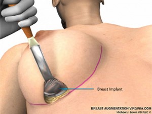 breast augmentation surgery illustrations