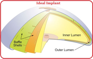 ideal breast implants construction virginia profile 