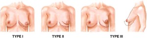 tuberous breast deformity scale
